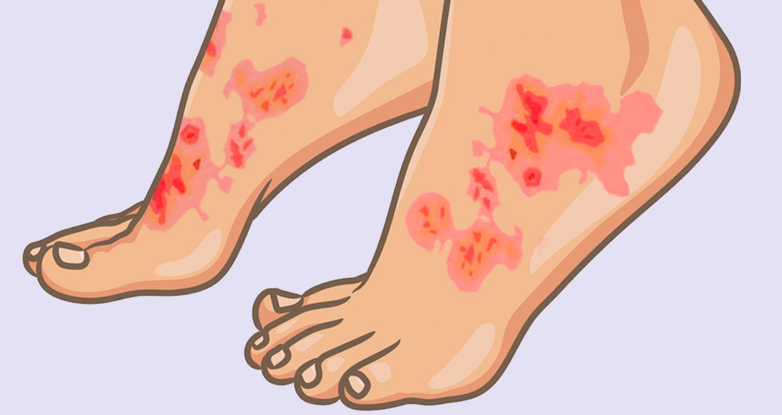 What Is Plaque Psoriasis? Symptoms, Causes & Treatments