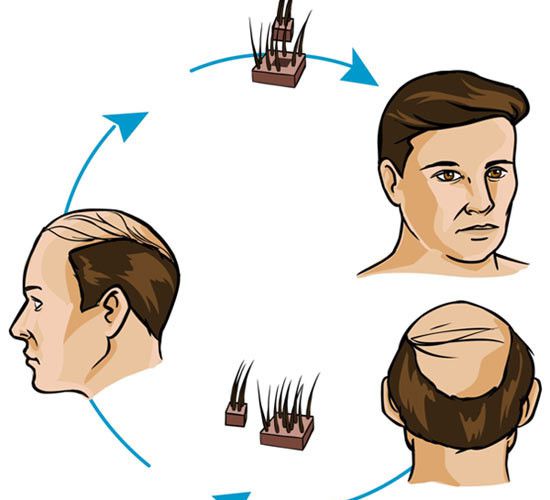 Have Proper Amount Of Iron And Get Rid From Hair Loss Men Hair