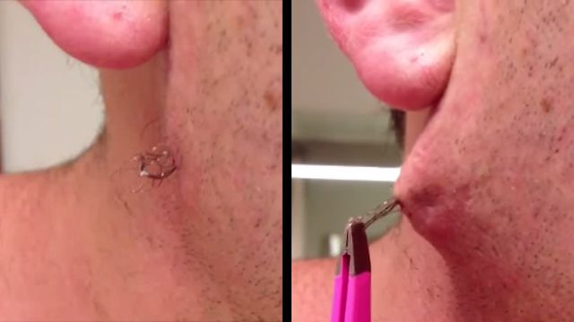 Lump On His Face Turns Out To Be World S Longest Ingrown Hair