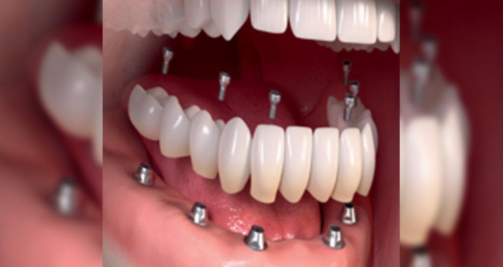 The Best Dental Implants Deals For Seniors