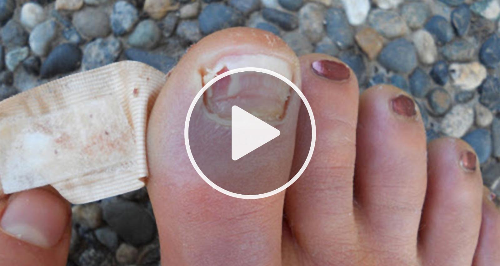 Try This Home Remedy Tonight To Get Rid Of Yellow Toenail Fungus