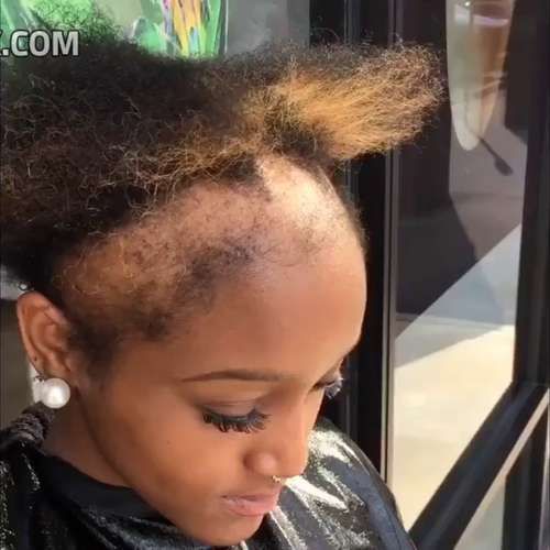 EEK! Black girl loses most of her hair due to weaves 