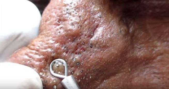 Punti neri naso uomo