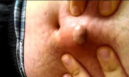This Massive Ingrown Hair Will Make Your Stomach Turn